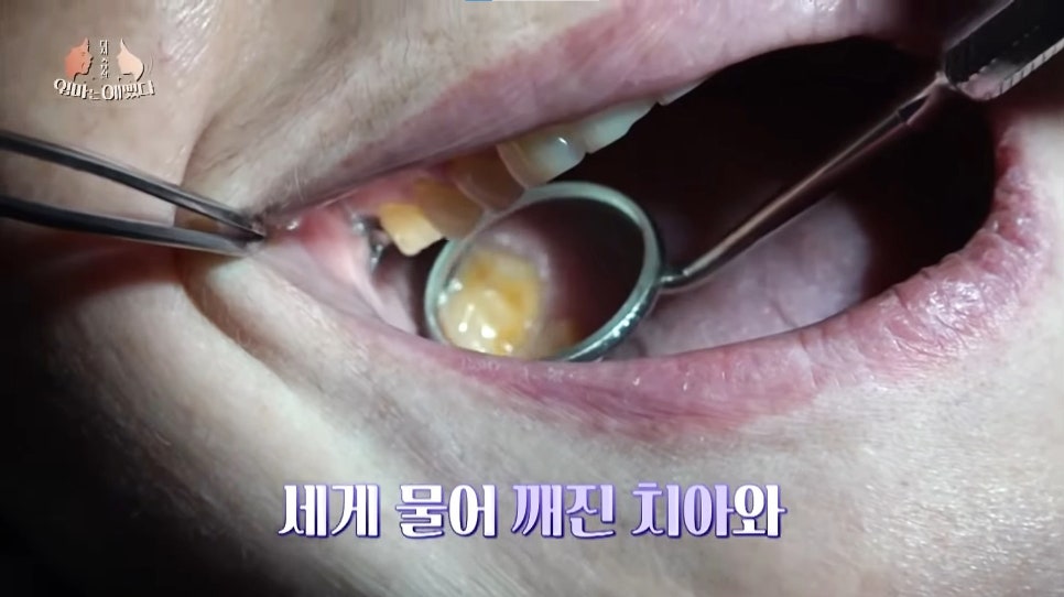 천안엄마의 치아노화, 미니쉬로 치아코팅하다 [엄마는예뻤다] 관련 이미지 6