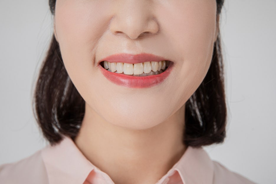 부정교합 교정 후 미니쉬 관련 이미지 1