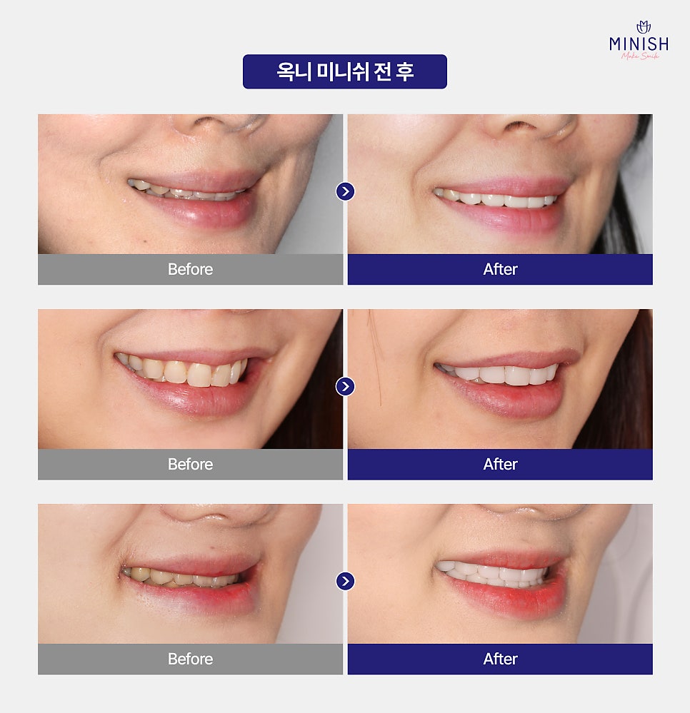 들어간 입, 합죽이 입 옥니 교정 심미와 기능 회복을 위한 최선의 방법은? 관련 이미지 6