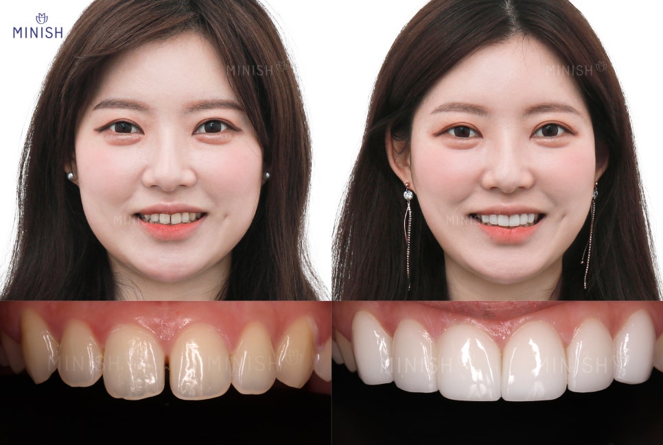 압구정 치과가 추천하는 벌어진치아 교정방법? 관련 이미지 5