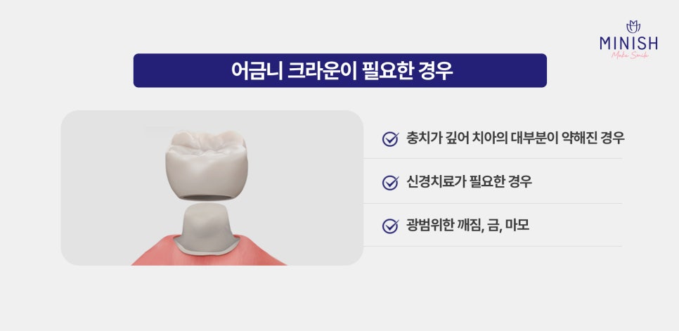 The Difference Between Molar Crowns and Minish from the Perspective of Preserving Teeth image 2