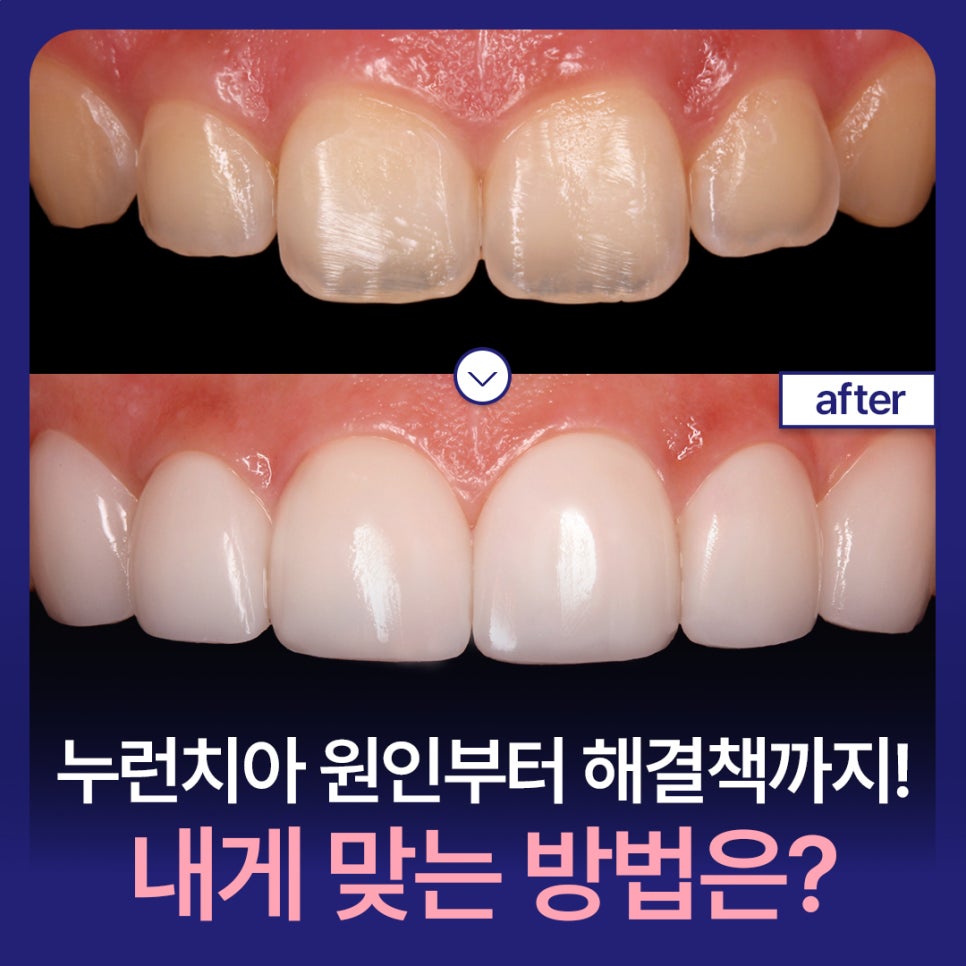 Yellow Teeth, From Causes to Solutions! Which Method Is Right for Me? image 1