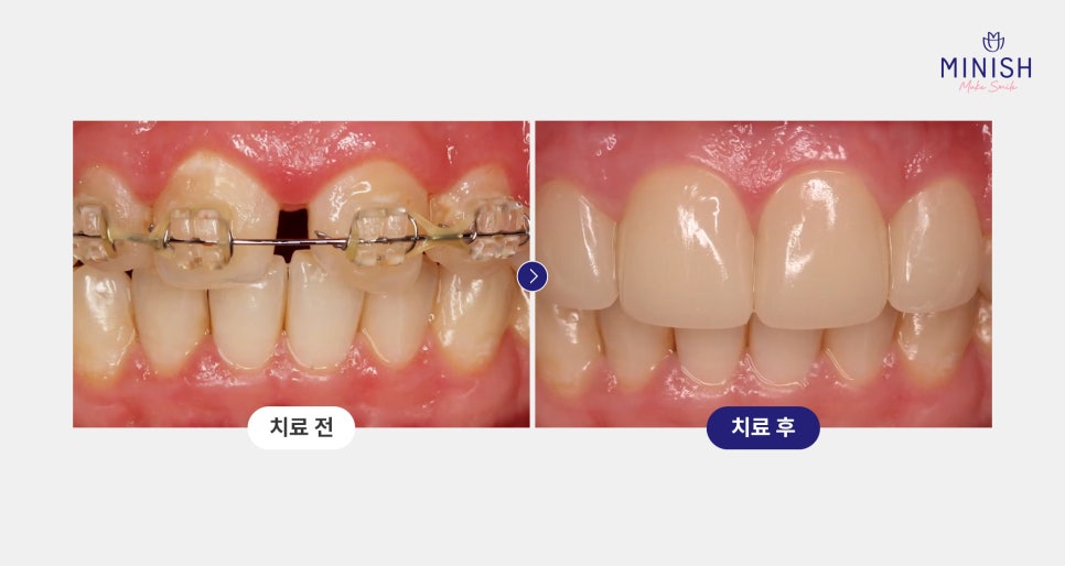 교정 후 앞니 벌어짐, 미니쉬로 해결하세요! 관련 이미지 6