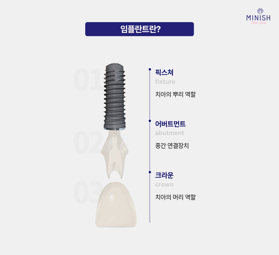 Implants, Only When Truly Necessary! Minish Dental Hospital’s Treatment Process for Protecting Natural Teeth image 2