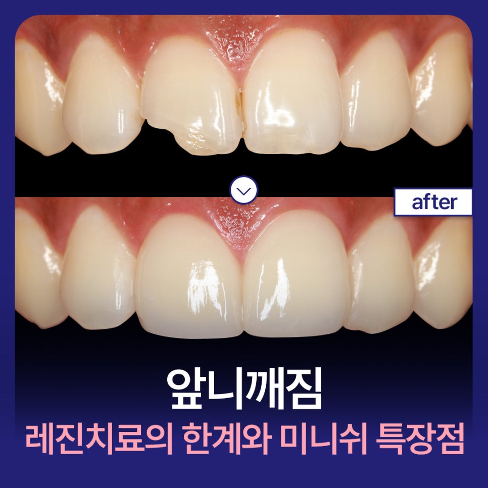 앞니깨짐 레진 치료의 한계와 치아복구솔루션 미니쉬 특장점 관련 이미지 1