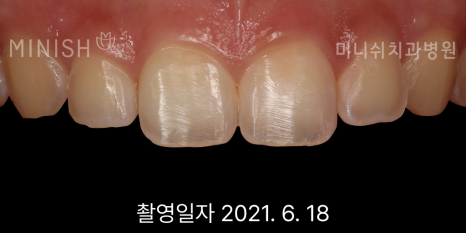 누런치아, 치아 미백으로 해결되지 않을 땐? 관련 이미지 10