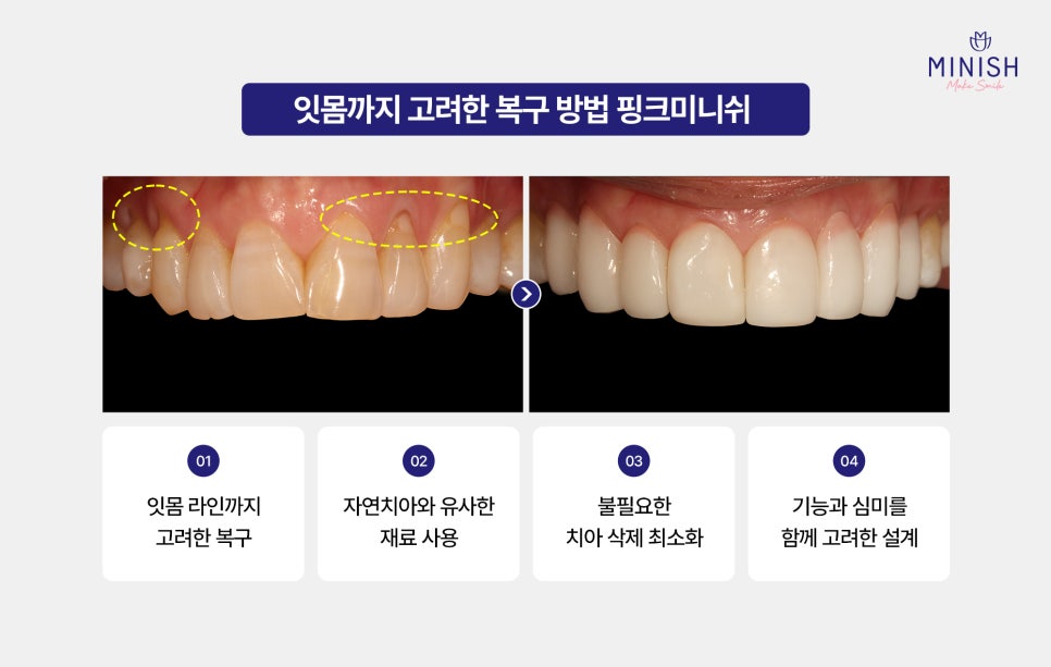 What Causes Tooth Notching? Symptoms and Treatment of Cervical Abrasion image 6