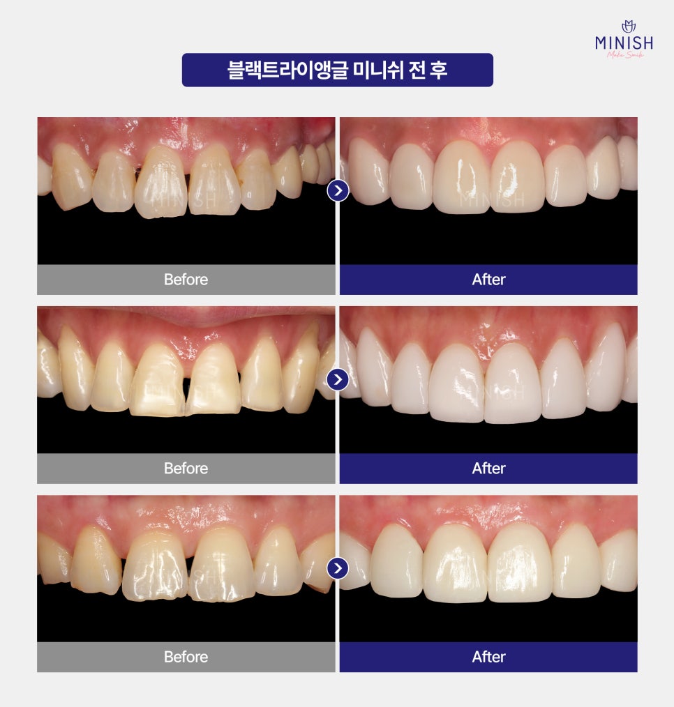 Black Triangles Between Teeth: Restore Them Healthily with Minishe! image 5
