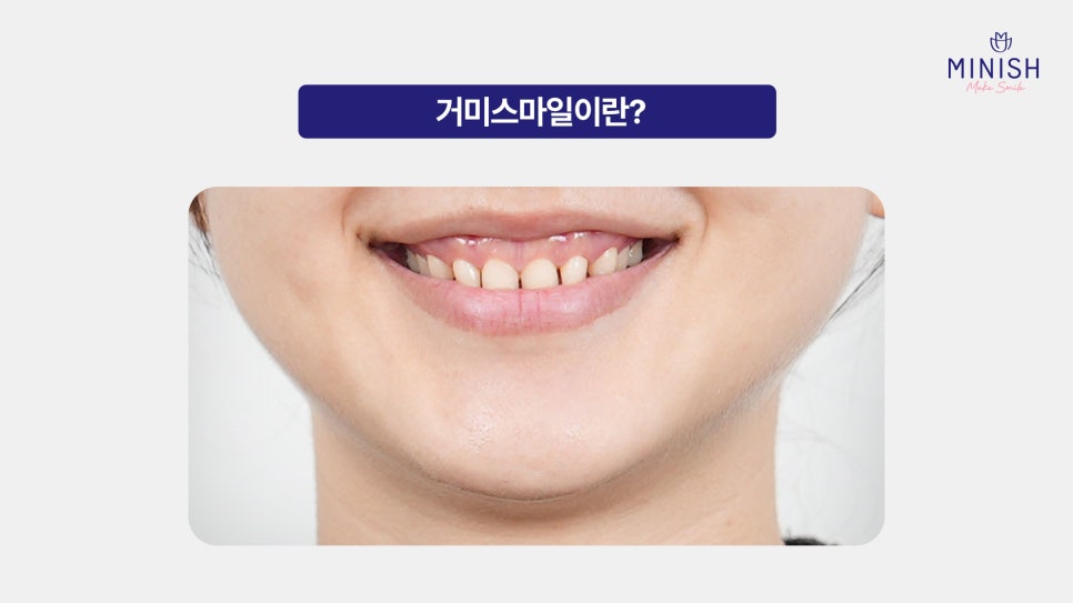 Gummy Smile: Why the Gums Show So Much When You Smile and How to Improve It image 2