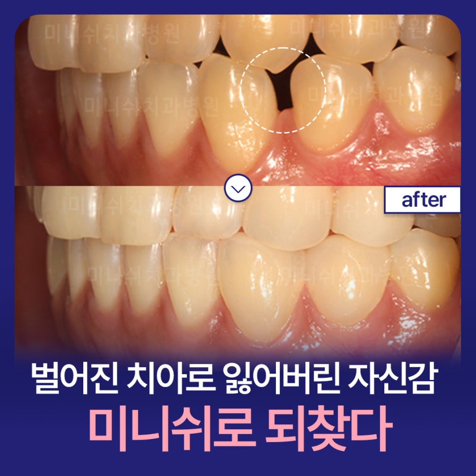 벌어진 치아로 잃어버린 자신감, 미니쉬로 되찾다 관련 이미지 1
