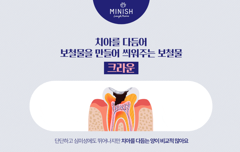 치아 수명 연장하는 법 관련 이미지 6
