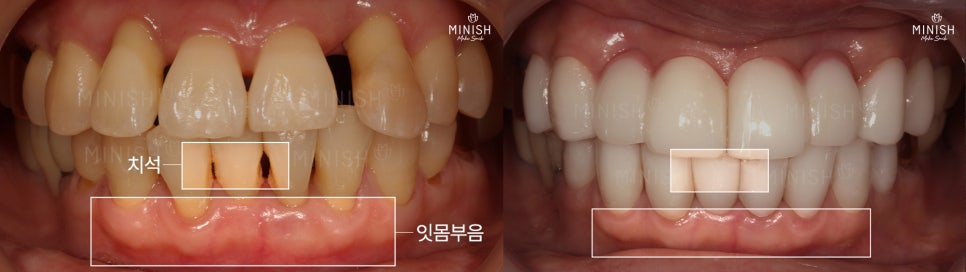 Are you wondering how to restore gums damaged by gum disease? image 6