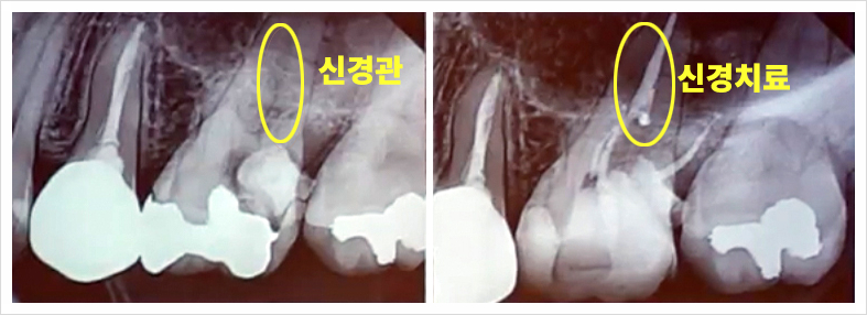 충치 치과 고민? 관련 이미지 7