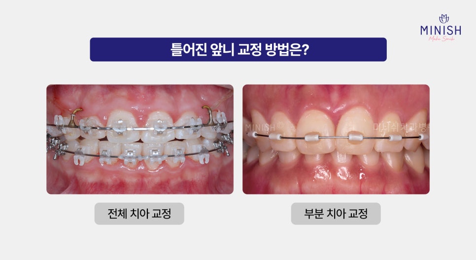 What Problems Can Crooked Front Teeth Cause If Left Untreated, and What Are the Fast Ways to Improve Them? image 4