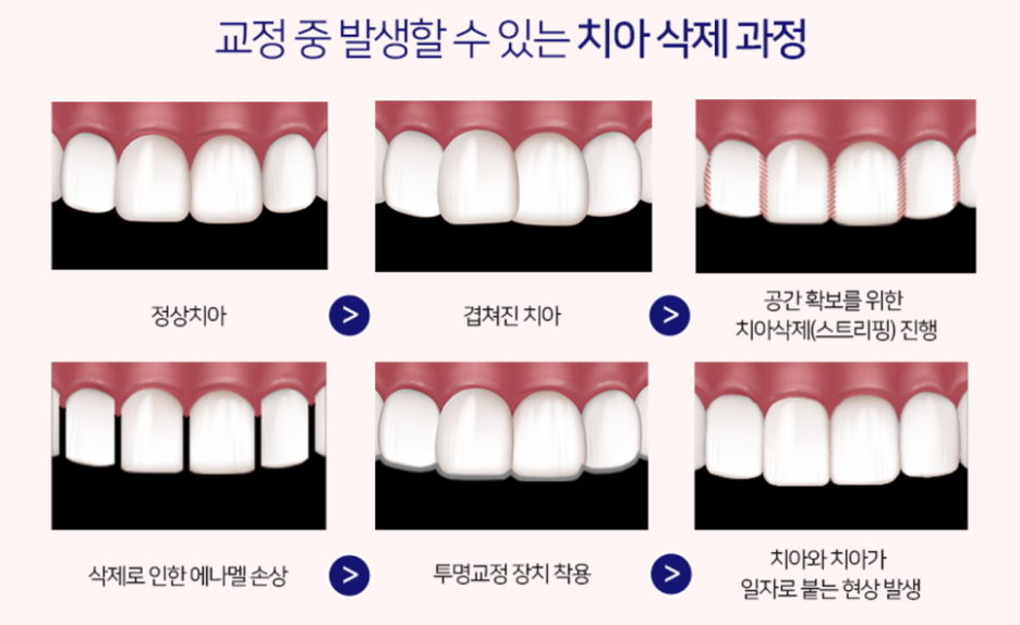 Is It Possible to Straighten Teeth in Just One Day? image 5