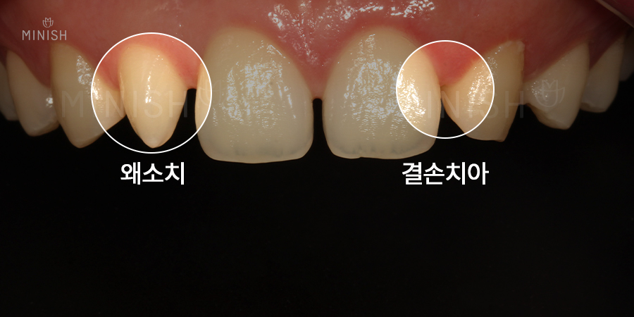 치아벌어짐 고민하지 말고 원데이미니쉬로 빠르게 관련 이미지 3