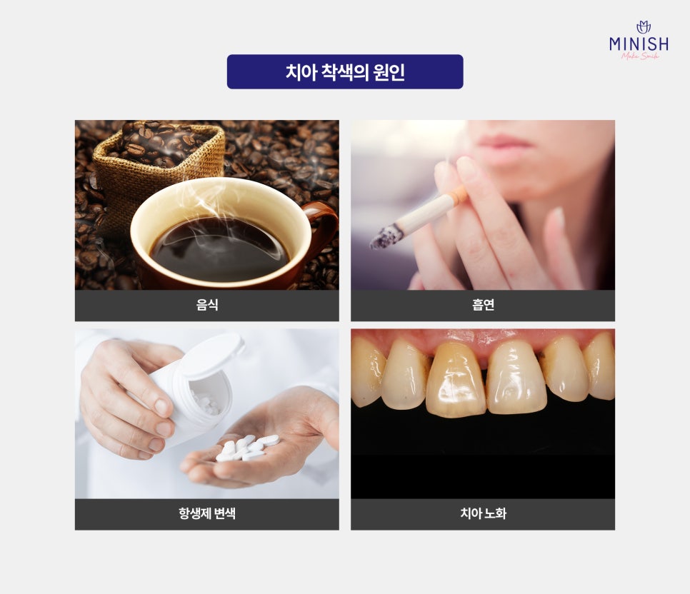 치아 착색 미백, 미니쉬 다양한 치료 방법과 예방법 관련 이미지 2