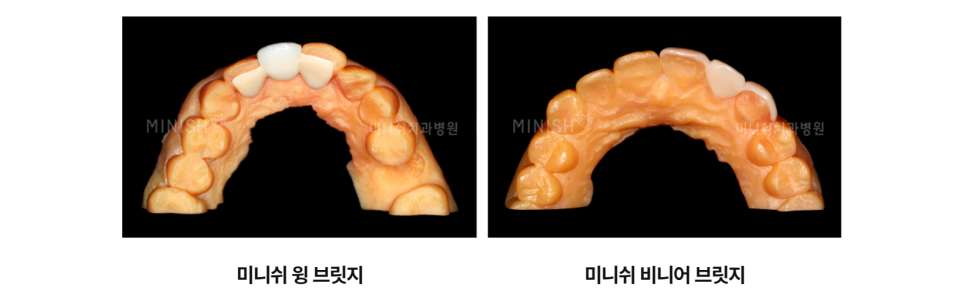 충치 근본 원인을 해결하는 미니쉬를 활용한 충치치료 관련 이미지 9