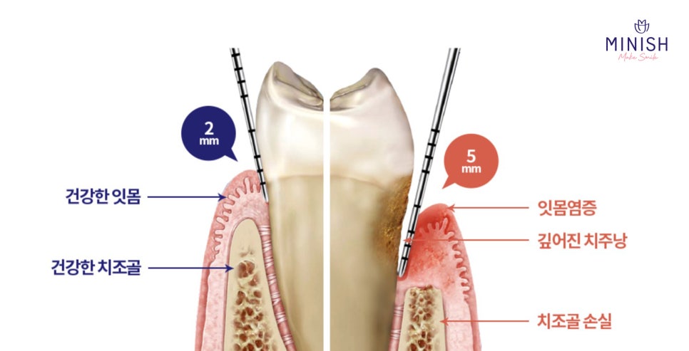 Swollen Gums and Bleeding? Warning Signs of Periodontal Disease image 2