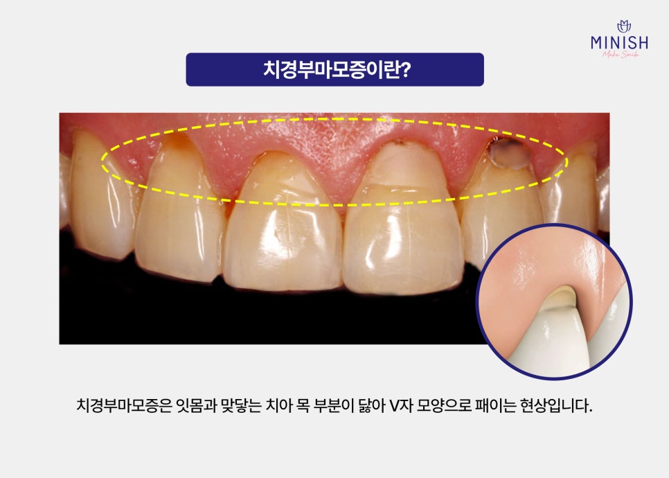 What Causes Tooth Notching? Symptoms and Treatment of Cervical Abrasion image 2