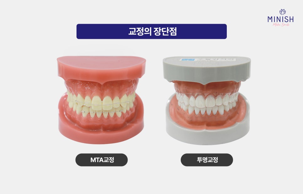 Worried About Gaps Between Your Teeth? Solve It Quickly with Minish While Protecting Your Natural Teeth! image 4
