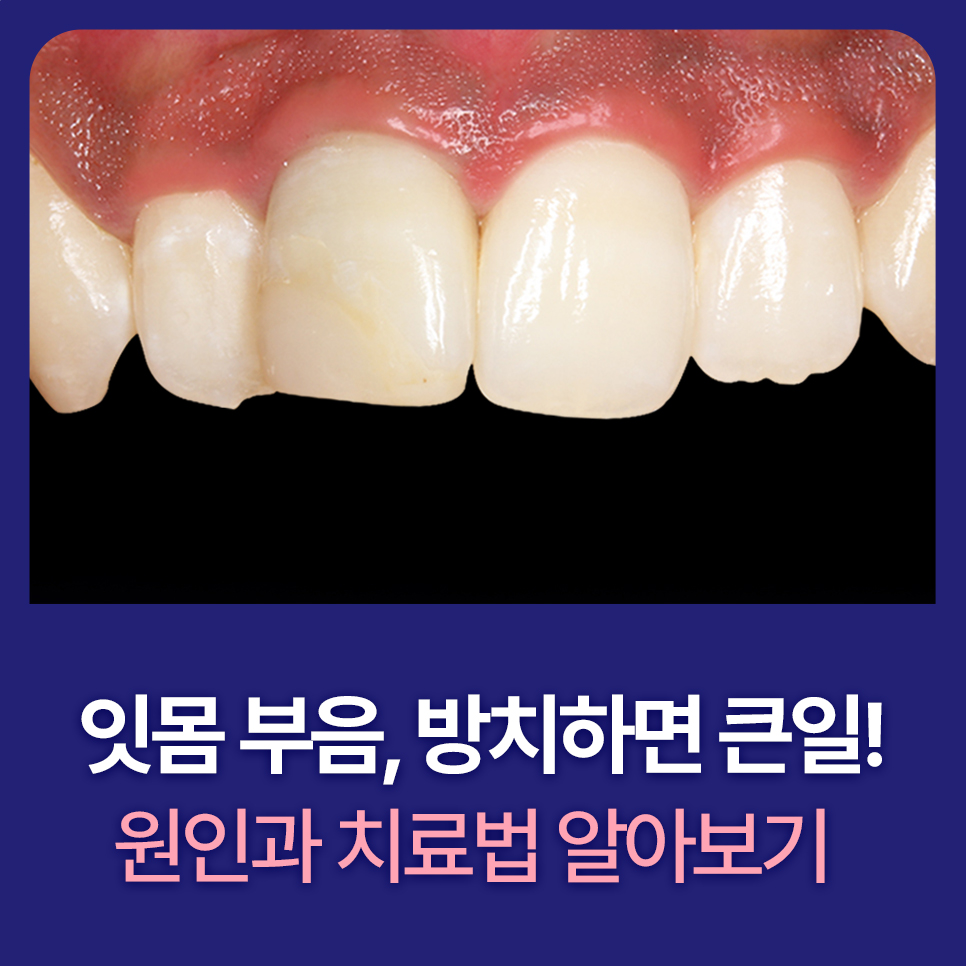 잇몸 부음, 방치하면 큰일! 원인과 치료법 알아보기 관련 이미지 1