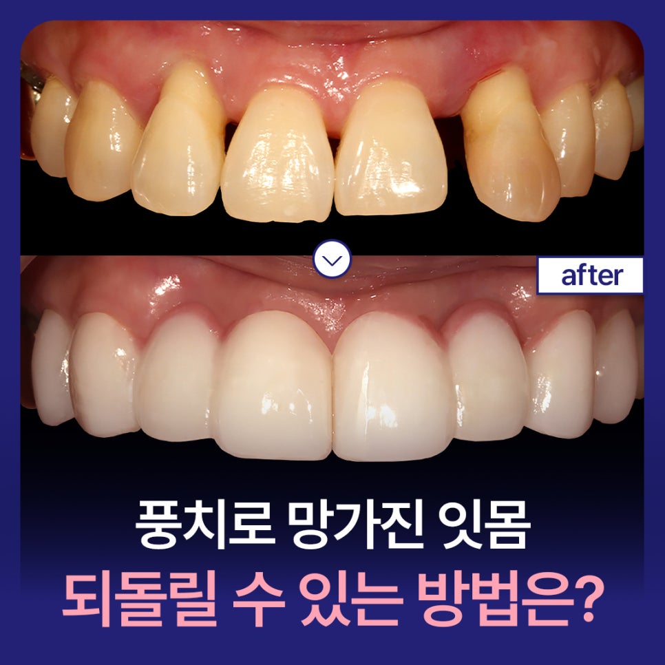 Are you wondering how to restore gums damaged by gum disease? image 1
