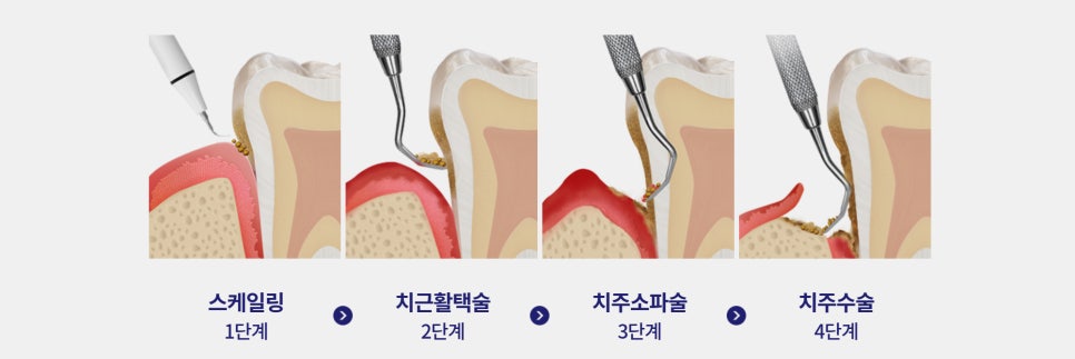 입냄새 원인 별 예방과 제거 치료 방법은? 관련 이미지 4