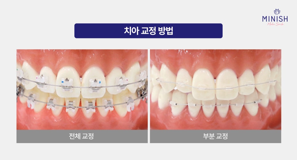 Crooked Teeth—Hesitating Because Orthodontic Treatment Might Take Too Long? Minish Harmony, Available in One Day image 3