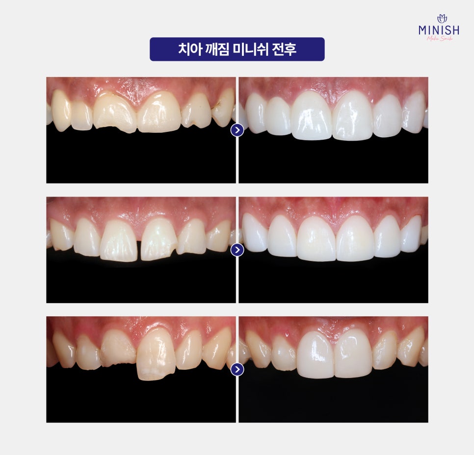 A Chipped Tooth: Which Treatment Should You Choose? A Comparison of Pros and Cons image 6