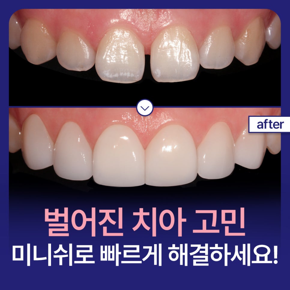 Worried About Gaps Between Your Teeth? Solve It Quickly with Minish While Protecting Your Natural Teeth! image 1
