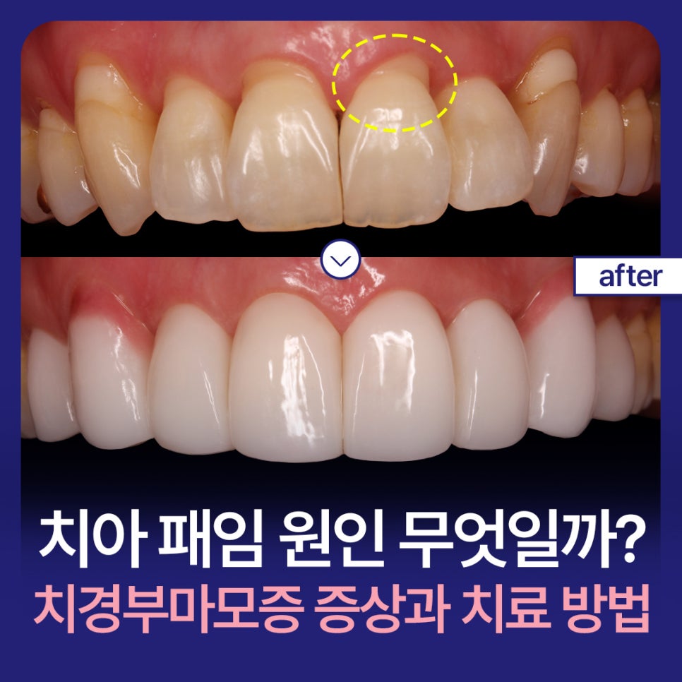 What Causes Tooth Notching? Symptoms and Treatment of Cervical Abrasion image 1