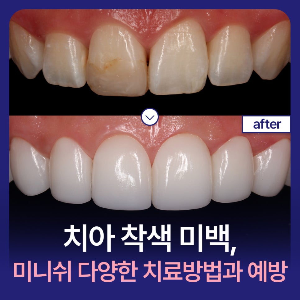 치아 착색 미백, 미니쉬 다양한 치료 방법과 예방법 관련 이미지 1