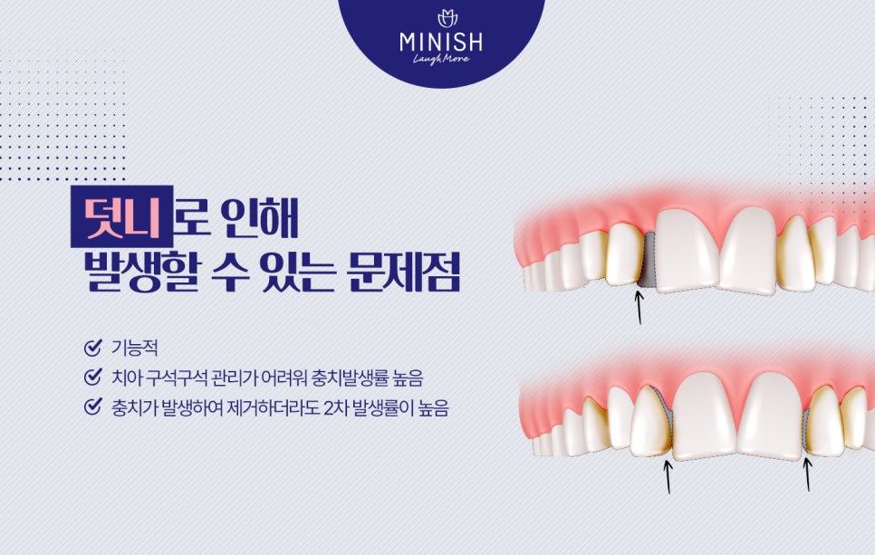 덧니교정, 왜 바로 잡아야 할까요? 관련 이미지 4