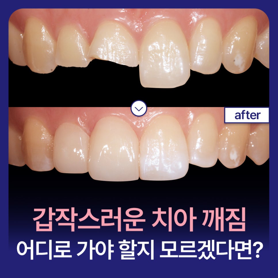 Sudden Tooth Breakage: Where Should You Go If You’re Not Sure? image 1