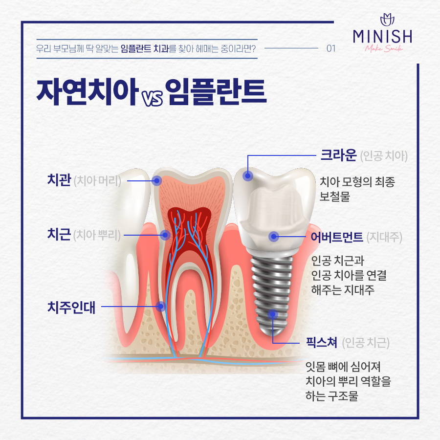 '임플란트'의 거의 모든 것 관련 이미지 11