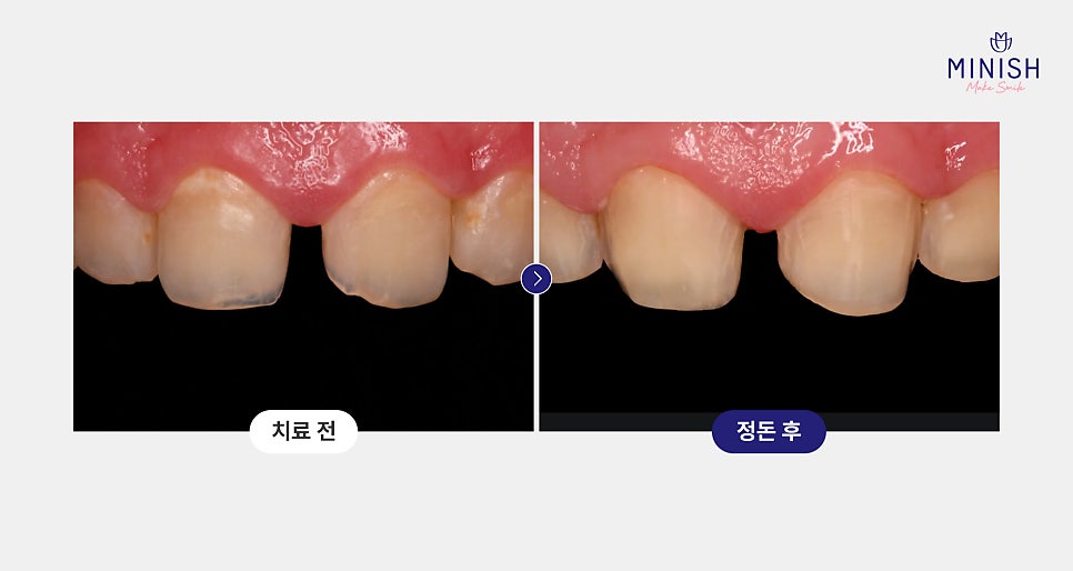 교정 후 앞니 벌어짐, 미니쉬로 해결하세요! 관련 이미지 5