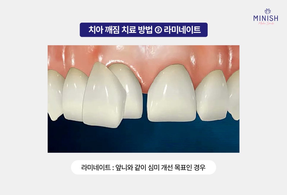 A Chipped Tooth: Which Treatment Should You Choose? A Comparison of Pros and Cons image 3