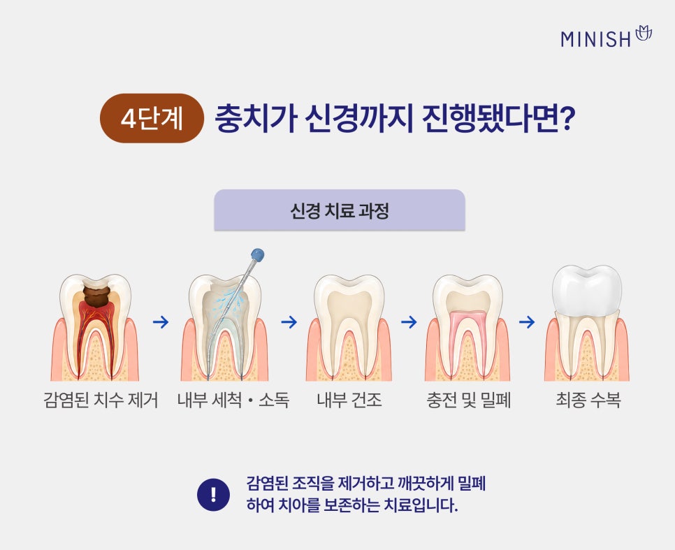 충치 단계별 치료 방법, 원데이 치료로 하루 만에 가능할까? 관련 이미지 6