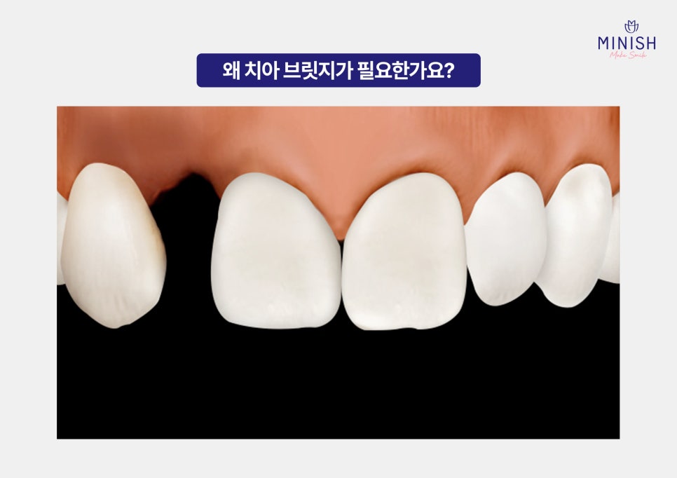 치아 브릿지 vs 미니쉬 브릿지 : 내 치아를 지키는 최적의 선택은? 관련 이미지 2