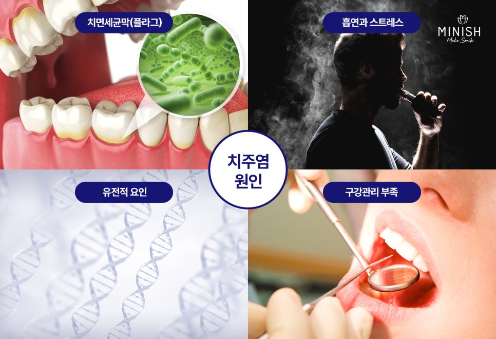 치주염 치료, 미니쉬가 제안하는 건강한 치아복구 솔루션 관련 이미지 3