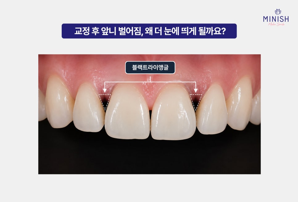 Gaps Between the Front Teeth After Orthodontic Treatment: Addressing Them with the Minish Line image 2