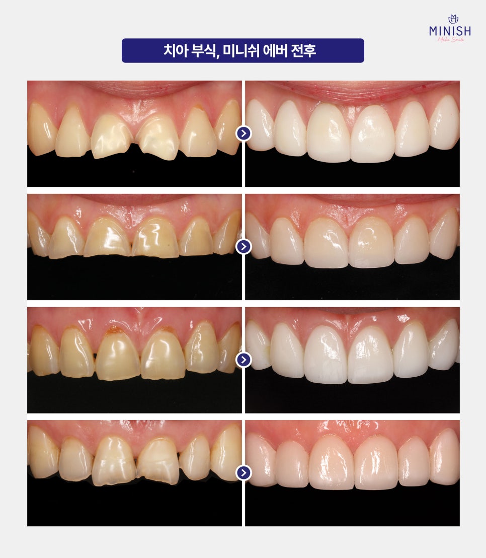 Tooth Erosion: If Left Untreated, It’s Hard to Recover! A Complete Guide to Treatment by Stage image 6