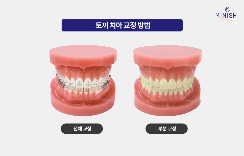 If Rabbit Teeth Are Stressing You Out, Improve Them Healthily with Minishe! image 3