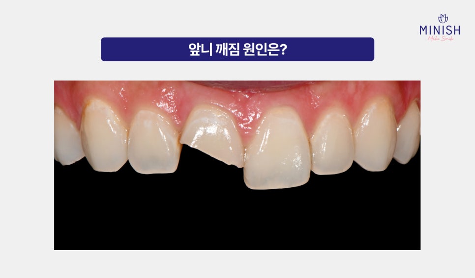 Sudden Chipped Front Tooth? Don’t Panic—Restore It with One-Day Minish! image 2