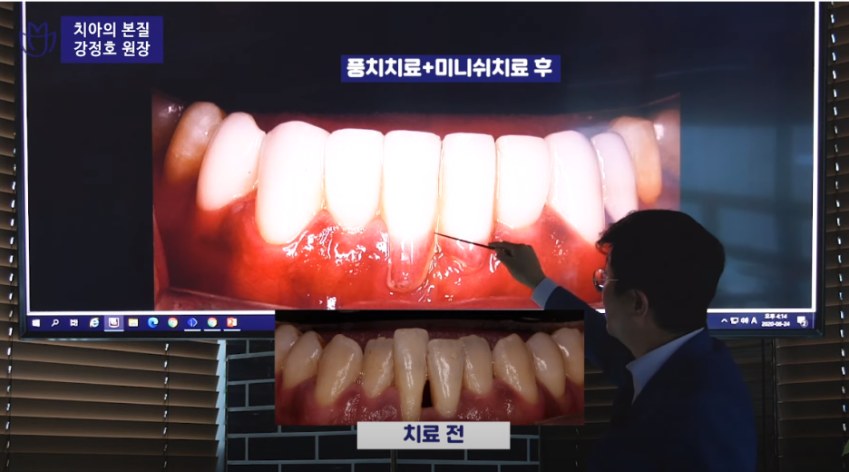 잇몸염증은 구강 적신호...가장 적극적인 잇몸치료는 미니쉬 관련 이미지 19