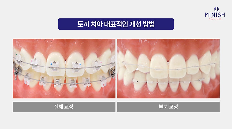 Prominent Rabbit Teeth: Change to a Healthier Smile in Just One Day with Minish image 3