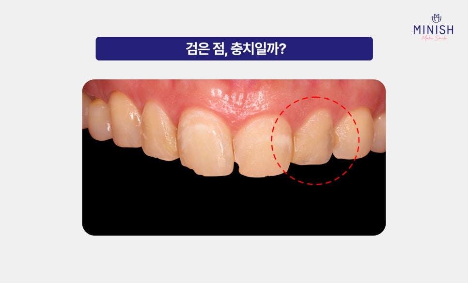 If You See a Black Spot on a Tooth, Is It Definitely a Cavity? image 2