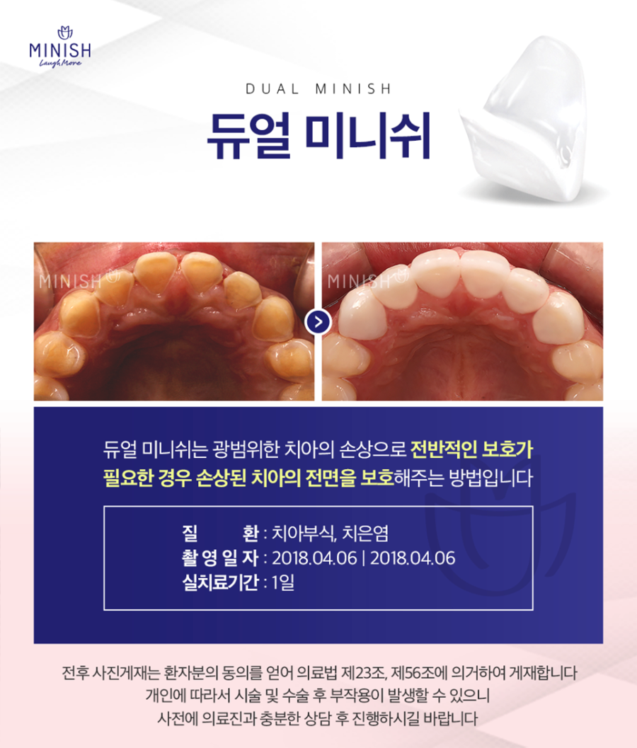 학동치과 앞니 손상으로 치아 보호 및 심미적 대처가 필요하다면 관련 이미지 6