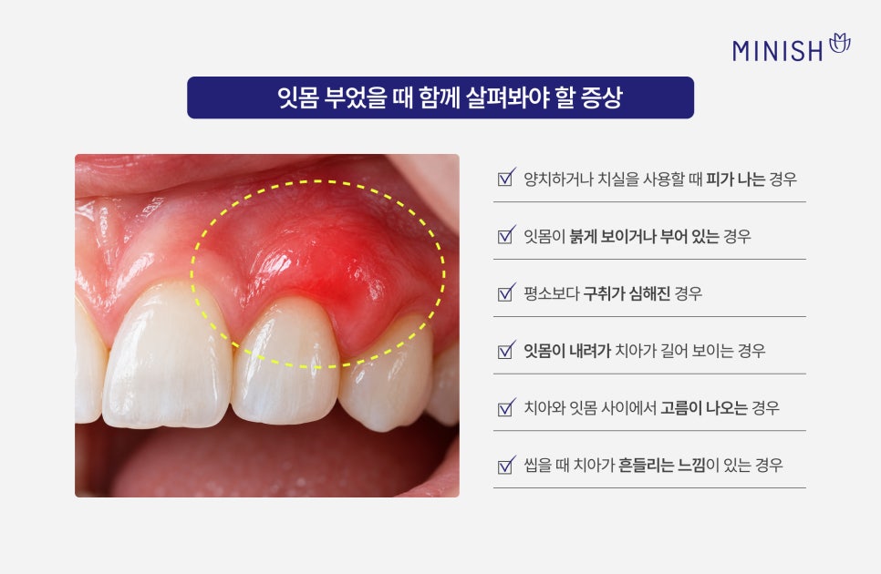 잇몸염증, 잇몸 부었을 때 필요한 치료는? 관련 이미지 3